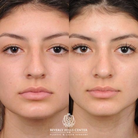 closed rhinoplasty cost