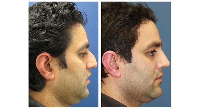 closed rhinoplasty cost