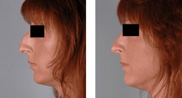 closed rhinoplasty cost