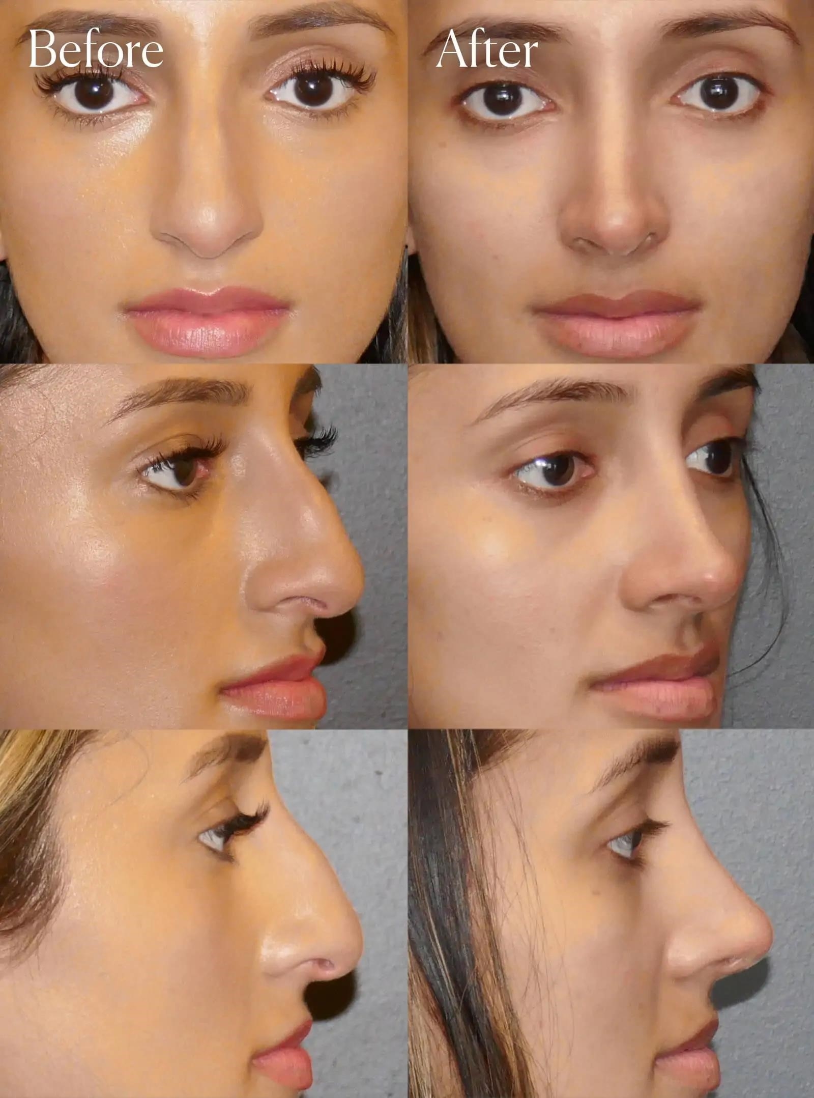 rhinoplasty surgery cost