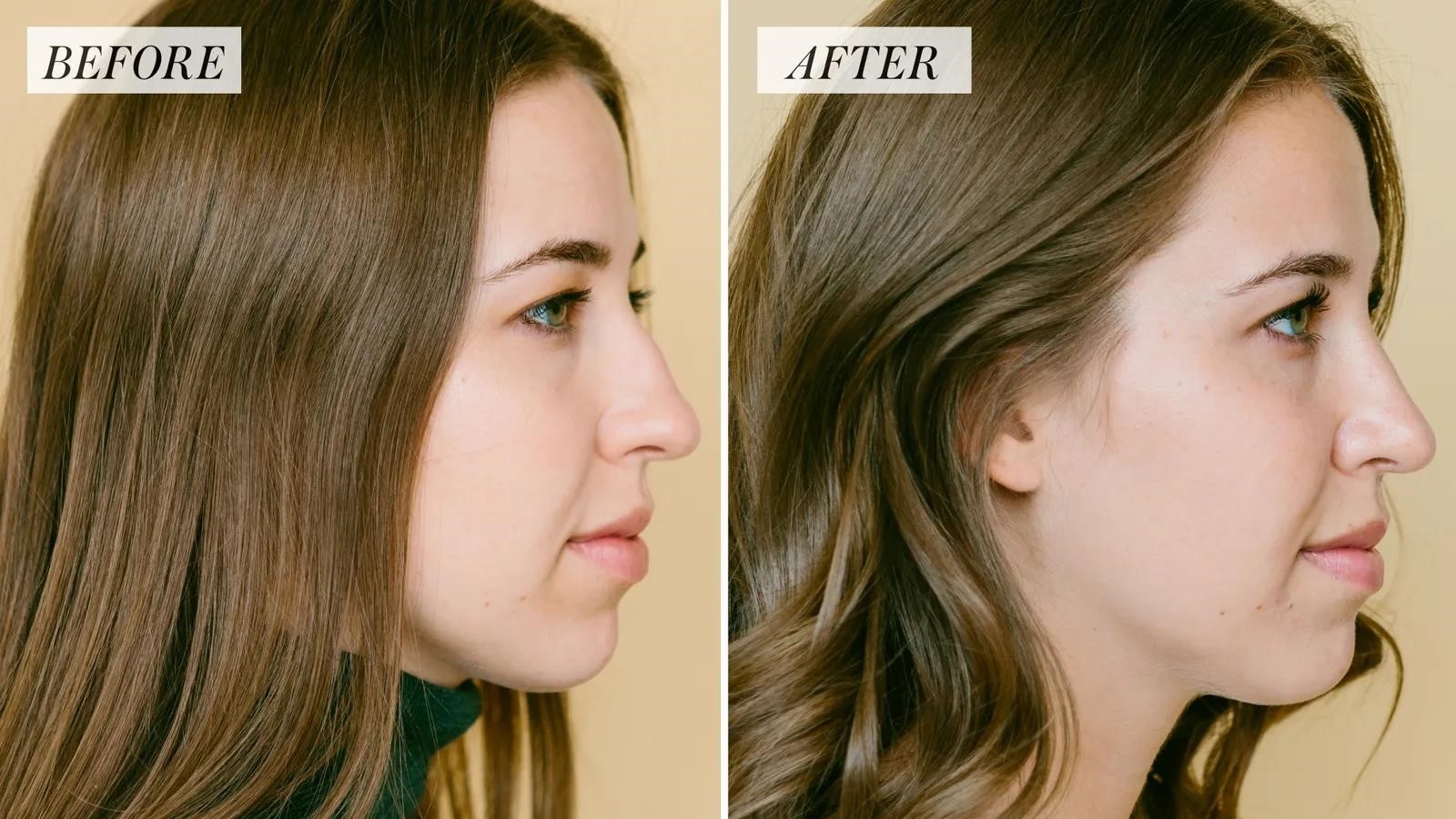 rhinoplasty surgery